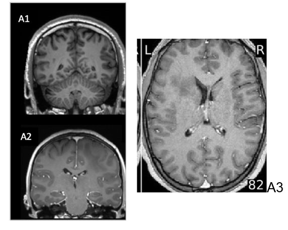 T1w with and without gadolinium