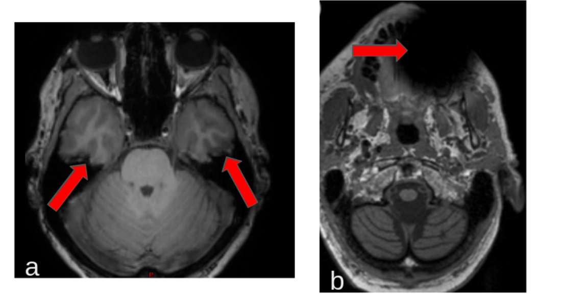 T1w suceptibility atifact