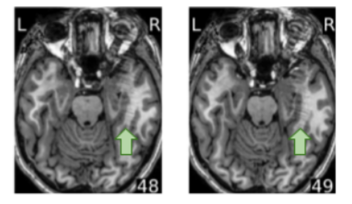 T1w eye spillover