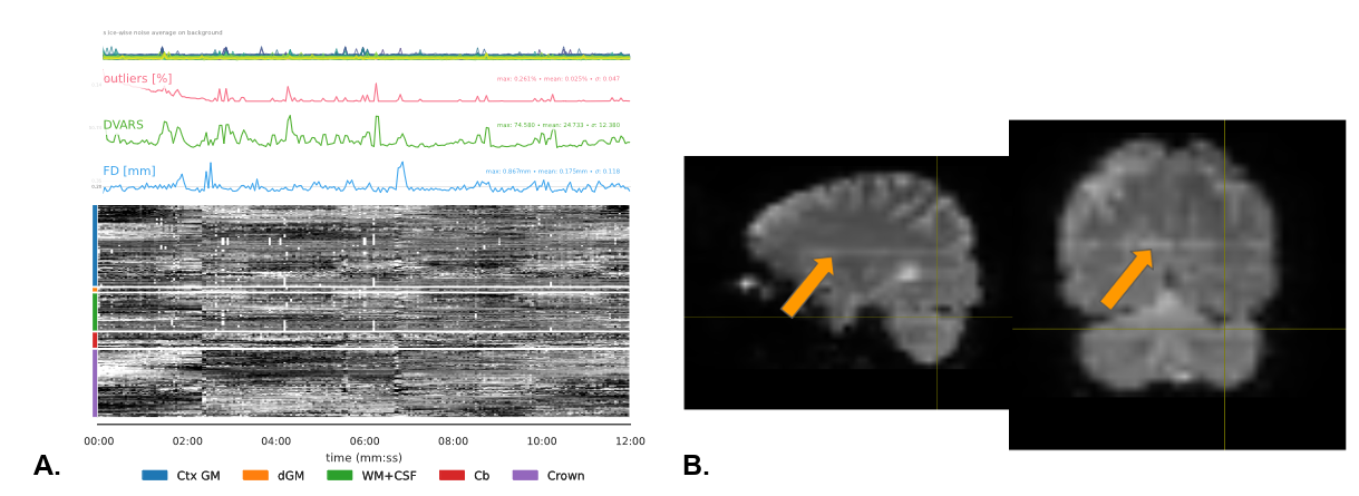 fMRI bright outliers