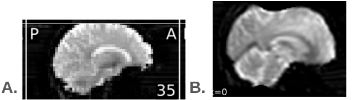fMRI coverage