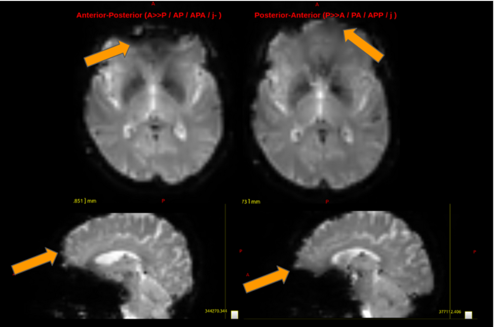 fMRI distortions