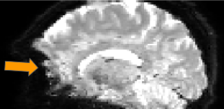 fMRI distortions 2