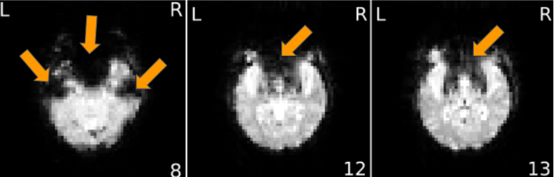 fMRI signal loss
