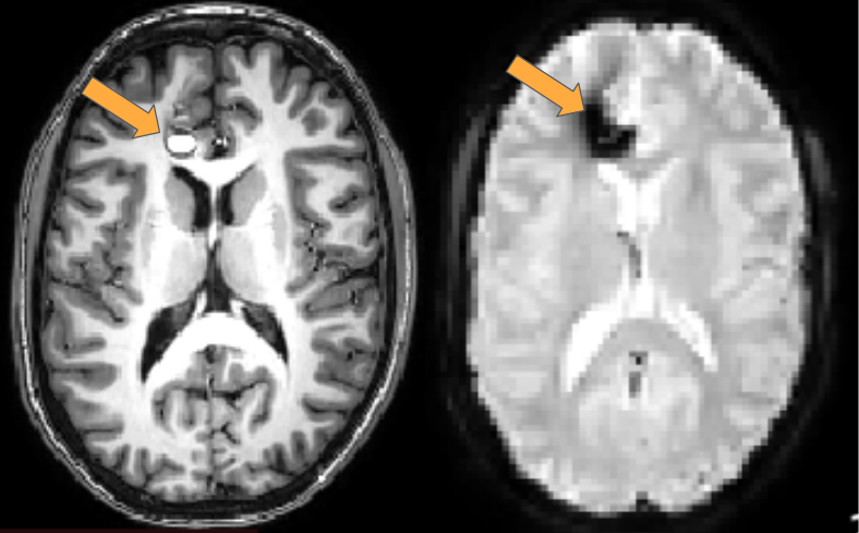 fMRI signal loss 2