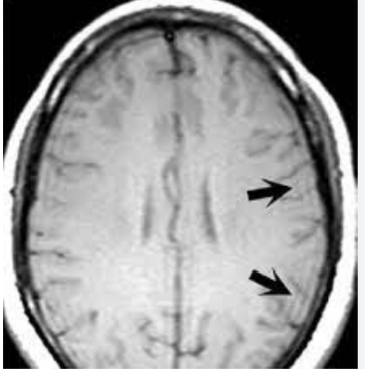 T1w with Gibbs artifact